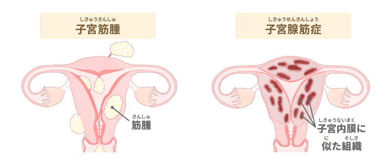 子宮筋腫や子宮腺筋症などの子宮の病気