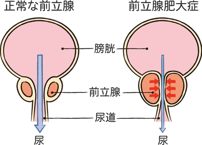 前立腺肥大